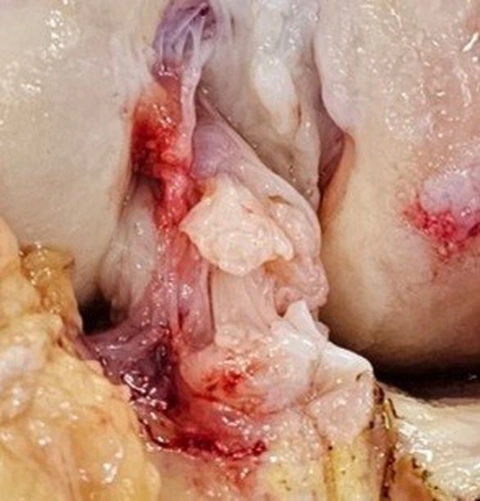 Đã qua thời đứt dây chằng chéo trước là buộc phải mổ- Ảnh 2. Hình minh họa một ca đứt dây chằng chéo trước bán phần nhưng chức năng DCCT vẫn còn - Ảnh: NVCC