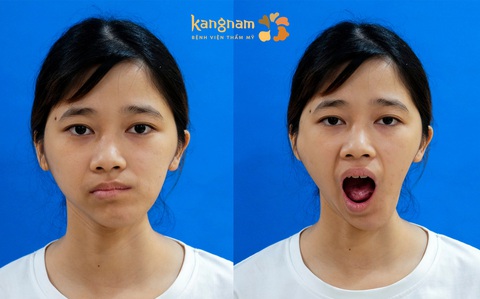 Khát khao được ‘lấp đầy’ của cô gái mặt lõm- Ảnh 1. Khát khao được ‘lấp đầy’ của cô gái mặt lõm- Ảnh 1.