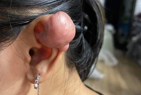 Tai nữ sinh sưng to như khối u dù đã được điều trị nhiều lần - Ảnh: NVCC Tai nữ sinh sưng to như khối u dù đã được điều trị nhiều lần - Ảnh: NVCC