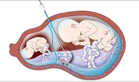 Nội soi buồng ối cứu sống 2 thai nhi mắc hội chứng truyền máu song thai- Ảnh 2. Hội chứng truyền máu song thai - Ảnh minh họa