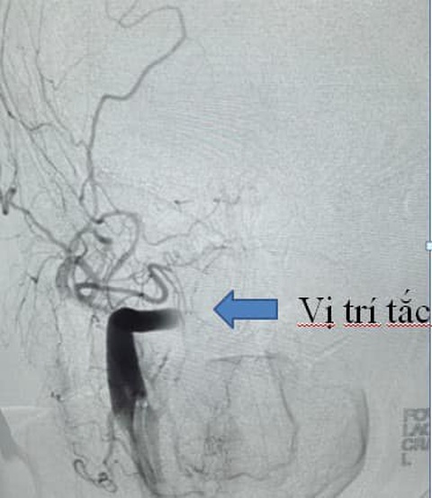 Đang khỏe mạnh có thể đột quỵ vì rung nhĩ- Ảnh 1. Rung nhĩ gây tắc động mạch ở bệnh nhân - Ảnh: Bệnh viện cung cấp