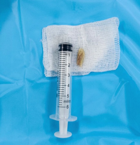 Mắc xương vịt 2cm ở thực quản và thanh quản, người phụ nữ không ăn không nói được- Ảnh 1. Miếng xương vịt có chiều dài khoảng 2cm đã mắc ba ngày trong thực quản khiến bệnh nhân không ăn uống được, khàn giọng - Ảnh: Bệnh viện cung cấp