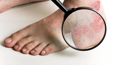 4 bệnh nấm da phải cẩn thận mùa mưa: Bác sĩ chỉ cách chăm sóc đúng- Ảnh 1. Cẩn thận các bệnh nấm da vào mùa mưa - Ảnh minh họa