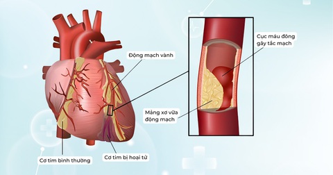 Đối tượng nào có nguy cơ hẹp động mạch vành và dấu hiệu nhận biết bệnh- Ảnh 1. Đối tượng nào có nguy cơ hẹp động mạch vành và dấu hiệu nhận biết bệnh- Ảnh 1.