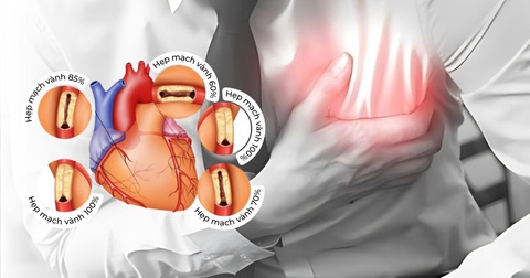 Đối tượng nào có nguy cơ hẹp động mạch vành và dấu hiệu nhận biết bệnh- Ảnh 2. Đối tượng nào có nguy cơ hẹp động mạch vành và dấu hiệu nhận biết bệnh- Ảnh 2.