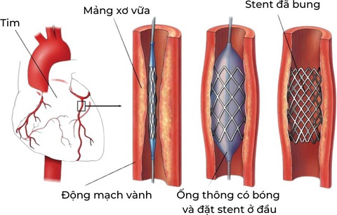 Đối tượng nào có nguy cơ hẹp động mạch vành và dấu hiệu nhận biết bệnh- Ảnh 3. Đặt stent cho bệnh nhân bị tắc hẹp mạch vành