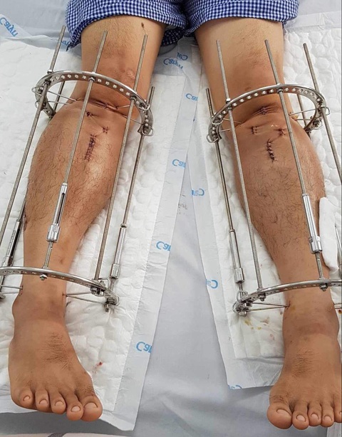 Với người trưởng thành, muốn cao thêm chỉ có biện pháp kéo dài chân ngoại khoa - Ảnh minh họa Với người trưởng thành, muốn cao thêm chỉ có biện pháp kéo dài chân ngoại khoa - Ảnh minh họa