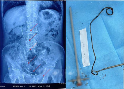 Ống sonde hơn 20cm 'ngủ quên' trong thận - bàng quang cụ ông 82 tuổi- Ảnh 2. Ống thông sonde JJ dài hơn 20cm đã đổi màu đen, bám đầy sỏi sau khi được lấy ra khỏi người bệnh nhân - Ảnh: TTXVN phát