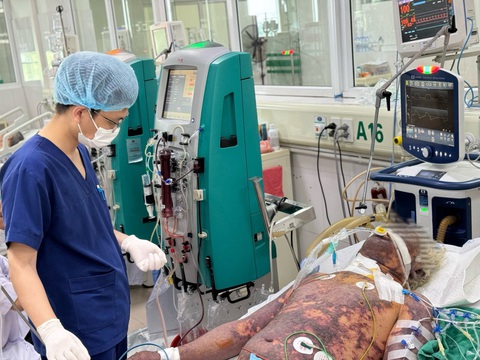Nam bệnh nhân nhập viện trong tình trạng nguy kịch, phát ban hoại tử da toàn thân - Ảnh: Bệnh viện cung cấp Nam bệnh nhân nhập viện trong tình trạng nguy kịch, phát ban hoại tử da toàn thân - Ảnh: Bệnh viện cung cấp