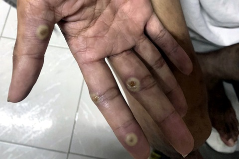 Chàng trai 28 tuổi ở Đồng Nai dương tính với bệnh đậu mùa khỉ- Ảnh 1. Nhiều nốt mụn mủ xuất hiện trên tay bệnh nhân do mắc đậu mùa khỉ - Ảnh: AN BÌNH