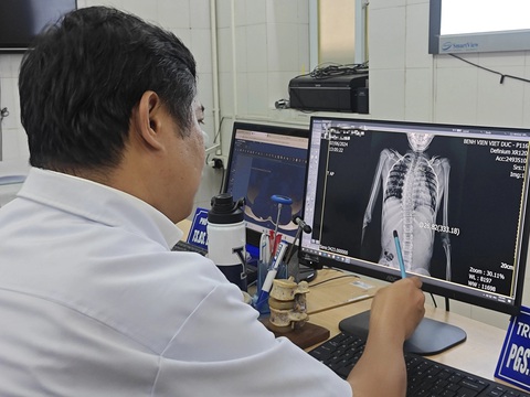 Nhiều trẻ cong vẹo cột sống thăm khám khi tình trạng đã nặng - Ảnh: DƯƠNG LIỄU Nhiều trẻ bị cong vẹo cột sống thăm khám khi tình trạng đã nặng - Ảnh: DƯƠNG LIỄU