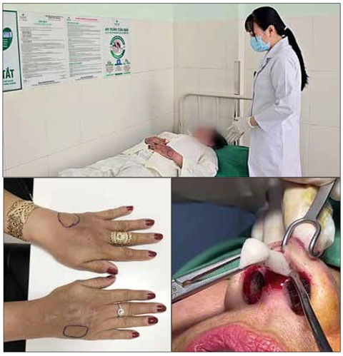 Nô nức đi làm đẹp theo... truyền miệng ở thôn quê, tai biến tràn lan- Ảnh 3. Các trường hợp tai biến do nâng mũi, tiêm chất làm đầy đến bệnh viện điều trị - Ảnh: Thái Lũy