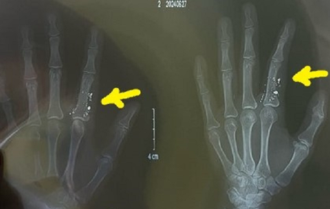 Nhiệt kế vỡ: Nguy hiểm nhiễm độc thủy ngân, nguy cơ lớn nếu dùng máy hút bụi dọn- Ảnh 1. Phim chụp ngón tay bệnh nhân chứa thủy ngân bị nhiễm độc từ nhiệt kế - Ảnh: BVCC