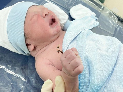 Chuyện hy hữu: Em bé chào đời mang theo vòng tránh thai của mẹ- Ảnh 1. Cháu bé chào đời mang theo vòng tránh thai của mẹ - Ảnh: Đ.N.