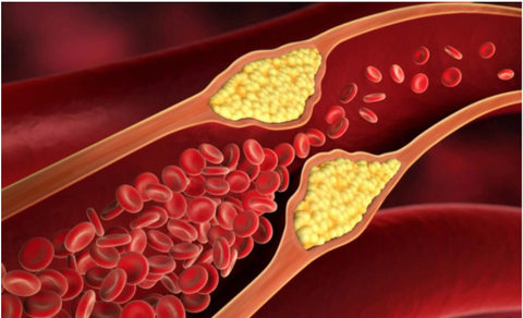 Kiêng ăn cholesterol dễ gây nhiều bệnh lý- Ảnh 1. Thừa hay thiếu cholesterol đều gây nhiều bệnh lý - Ảnh minh họa