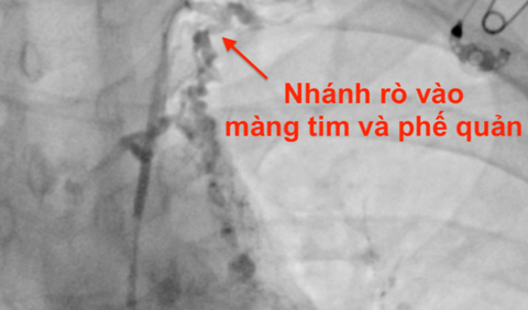 Hình ảnh chụp tim phổi của bệnh nhân - Ảnh: Bệnh viện cung cấp Hình ảnh chụp tim, phế quản của bệnh nhân - Ảnh: Bệnh viện cung cấp