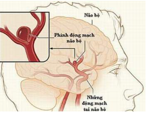 Vỡ phình mạch máu não có nguy cơ tư vong cao - Ảnh: Bệnh viện cung cấp Vỡ phình mạch máu não có nguy cơ tử vong cao - Ảnh: Bệnh viện cung cấp