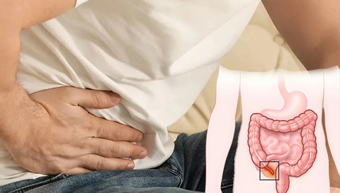 Viêm ruột thừa có thể nguy hiểm đến tính mạng nếu không được chẩn đoán kịp thời - Ảnh: Bệnh viện Hữu nghị Việt Đức Viêm ruột thừa có thể nguy hiểm đến tính mạng nếu không được chẩn đoán kịp thời - Ảnh: Bệnh viện Hữu nghị Việt Đức