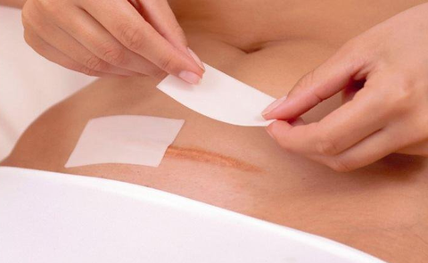 Chăm sóc vết mổ ra sao để tránh nhiễm trùng và sẹo lồi?- Ảnh 1. Chăm sóc vết mổ ra sao để tránh nhiễm trùng và sẹo lồi?- Ảnh 1.