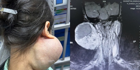 14 năm sau khi xuất hiện khối u, bà D. (57 tuổi, trú Hải Phòng) mới đến viện thăm khám - Ảnh: Bệnh viện cung cấp Trì hoãn 14 năm không điều trị, người phụ nữ suýt mất mạng vì khối u khổng lồ trên mặt- Ảnh 1.