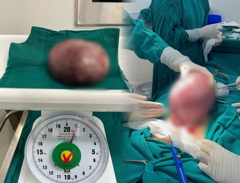 Khối u xơ tử cung 'khủng', người phụ nữ tưởng bị béo phì- Ảnh 2. Khối u có kích thước lên tới 20cm, chèn ép vào buồng tử cung của bệnh nhân - Ảnh: MINH HẢI