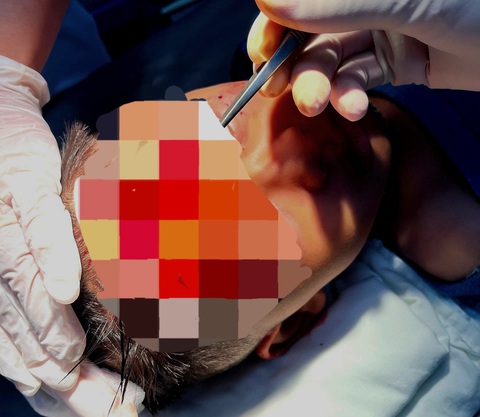 Trong ảnh các bác sĩ đang tiến hành điều trị cho bé trai 7 tuổi bị chó cắn vào vùng mặt - Ảnh: Bệnh viện cung cấp Các bác sĩ tiến hành điều trị cho bé trai 7 tuổi bị chó cắn vào vùng mặt - Ảnh: Bệnh viện cung cấp