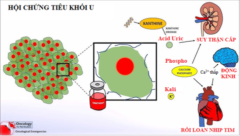Bệnh nhân ung thư cẩn trọng mắc hội chứng tiêu khối u - Ảnh 1. Hội chứng tiêu khối u là gì? - Ảnh 1.