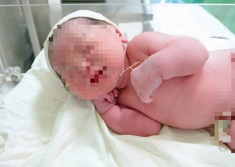 Bé gái 'vượt chông gai' chào đời cùng vòng tránh thai của mẹ - Ảnh 1. Bé gái 'vượt chông gai' chào đời cùng vòng tránh thai của mẹ - Ảnh 1.
