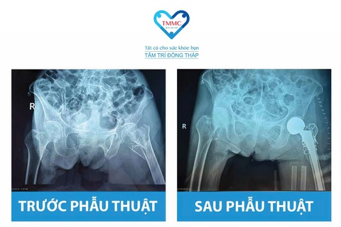 Gần 100 tuổi có thay khớp háng được không? - Ảnh 1.