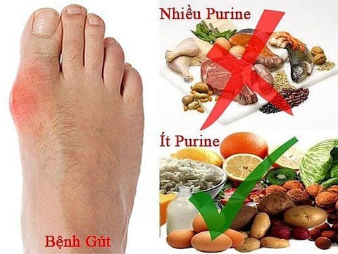 Mắc bệnh gút có cần kiêng hoàn toàn đạm? - Ảnh 1. Mắc bệnh gout có cần kiêng hoàn toàn đạm? - Ảnh 1.