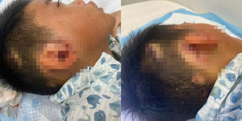 Sang nhà bà chơi, bé trai 8 tuổi bị chó cắn suýt mất vành tai - Ảnh 1. Sang nhà bà chơi, bé trai suýt mất vành tai vì bị chó cắn - Ảnh 1.