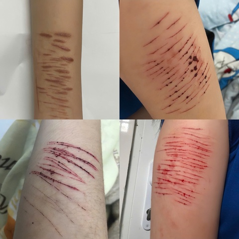 Trẻ có thể tự gây thương tích khi stress, làm sao để giúp trẻ vượt qua? - Ảnh 1. Trẻ có thể tự gây thương tích khi stress, làm sao để giúp trẻ vượt qua? - Ảnh 1.
