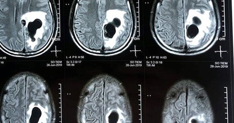 Co giật, méo miệng vì sán làm tổ trong não: Nguyên nhân từ món ăn khoái khẩu của người Việt - Ảnh 1. Co giật, méo miệng vì sán làm tổ trong não: Nguyên nhân từ món ăn khoái khẩu của người Việt - Ảnh 1.