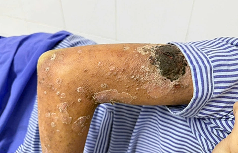 Dùng kiến ba khoang đắp chữa ngứa, nam thanh niên chảy dịch toàn thân - Ảnh 1. kiến ba khoang - Ảnh 1.