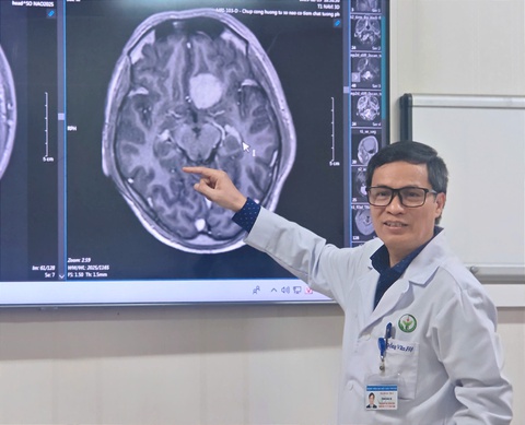 Lần đầu tiên tại Việt Nam: Cắt bỏ khối u não qua vết mổ nội soi trên cung mày - Ảnh 1. Lần đầu tiên tại Việt Nam: Cắt bỏ khối u não qua vết mổ nội soi trên cung mày - Ảnh 1.