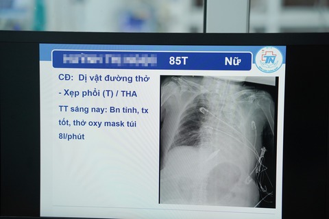 Bệnh viện Thống Nhất cứu cụ bà 85 tuổi bị hóc xoài - Ảnh 2.