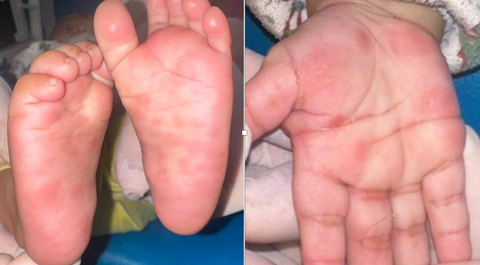 Nổi ban đỏ bàn tay, chân, biểu hiện cẩn trọng trẻ mắc giang mai - Ảnh 1. giang mai - Ảnh 1.
