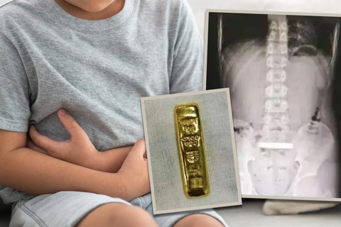 Bé trai Trung Quốc nuốt thỏi vàng 100g, phải phẫu thuật để lấy ra - Ảnh 1.