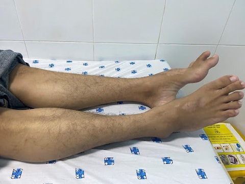 Tê yếu chi dưới lâu ngày có thể là biểu hiện của bệnh hiếm? - Ảnh 1.
