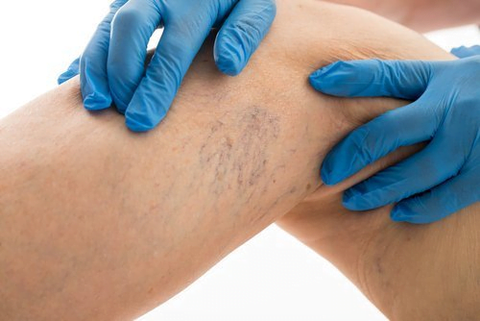 Nhân viên y tế dễ mắc suy giãn tĩnh mạch - Ảnh 1.