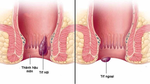 5 thủ phạm ‘giấu mặt’ gây ra nỗi ám ảnh mang tên bệnh trĩ - Ảnh 1. bệnh trĩ - Ảnh 1.