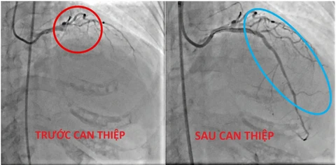 nhồi máu cơ tim - Ảnh 1.