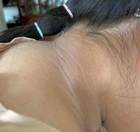 Dấu gai đen ở da: Không phải vệ sinh kém, cảnh báo sức khỏe xấu cần lưu ý - Ảnh 1.