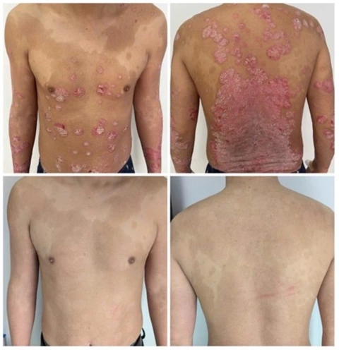 vảy nến - Ảnh 1.