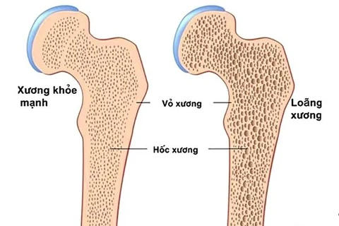 Làm gì để phòng ngừa bệnh loãng xương? - Ảnh 1. Làm gì để phòng ngừa bệnh loãng xương? - Ảnh 1.
