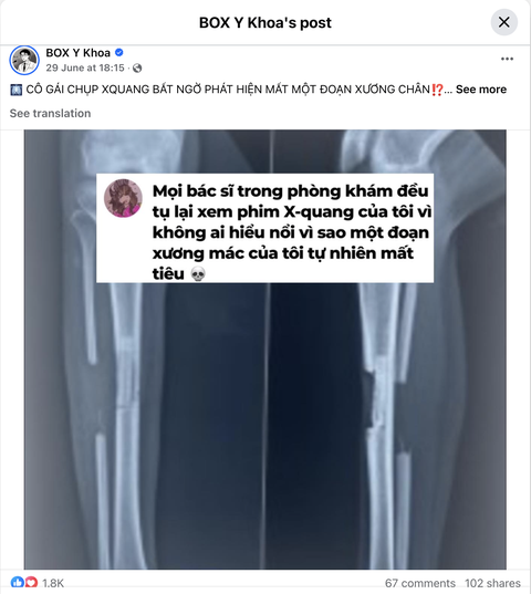Cô gái chụp X-quang bất ngờ thấy mất xương chân - Ảnh 1. chụp X-quang - Ảnh 1.