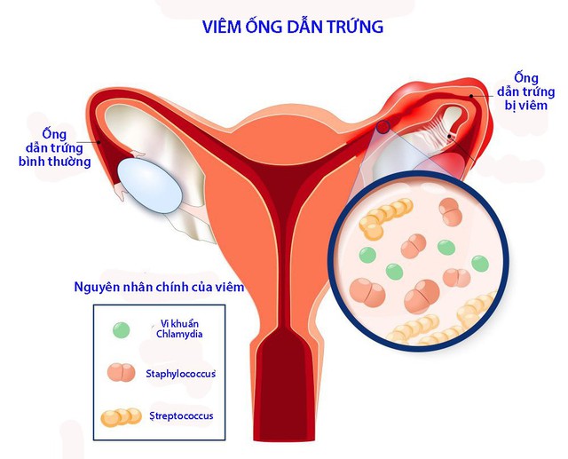 Các biến chứng thường gặp của viêm ống dẫn trứng - Ảnh 1.