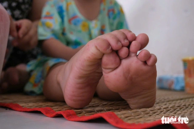 Ho Chi Minh City detects return of EV71 as severe hand, foot and mouth cases rise- Ảnh 1.