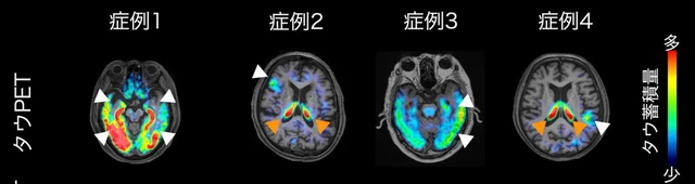 Middle- to old-age depression likely tied to dementia - Ảnh 1.