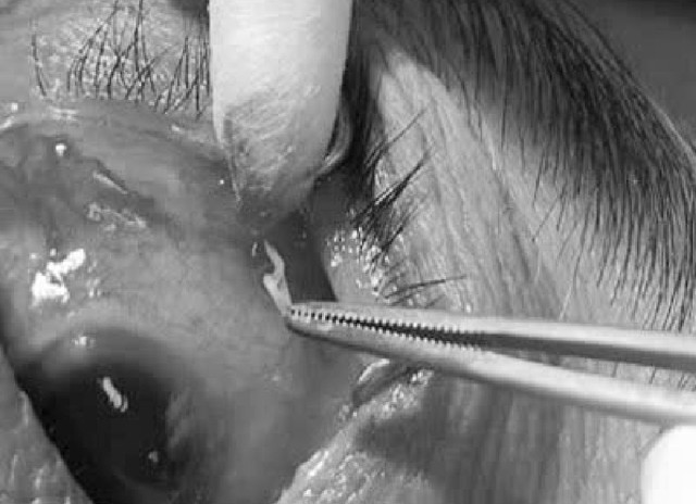 Doctors remove 4cm parasitic worm from woman’s eye in northern Vietnam - Ảnh 1. Doctors remove 4cm parasitic worm from woman’s eye in northern Vietnam - Ảnh 1.